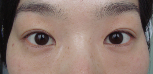 術后1年,雙眼對稱,重瞼弧度自然。