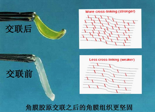 角膜交聯前后變化